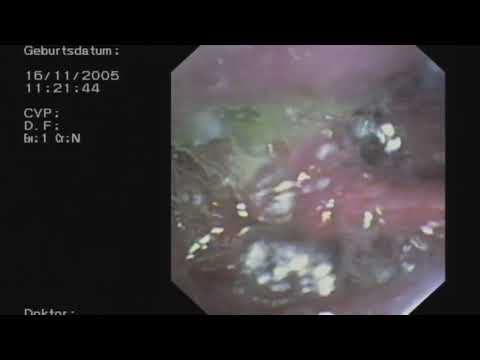 Mass Residuen ge Hypopharynx